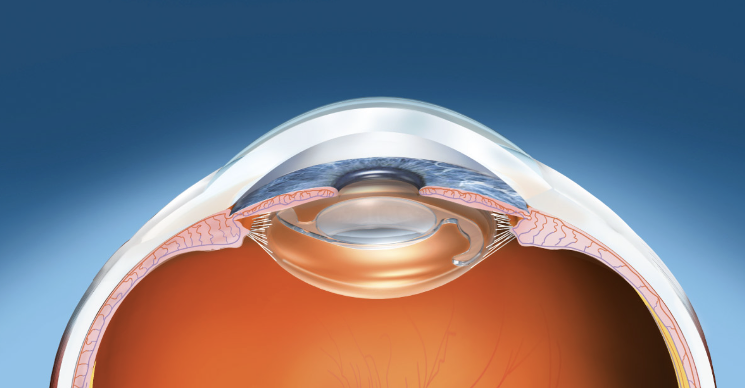 Cirurgia de catarata — exame e procedimento