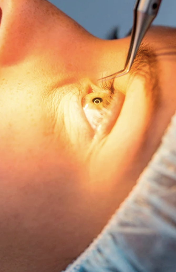 Procedimento de cirurgia ocular