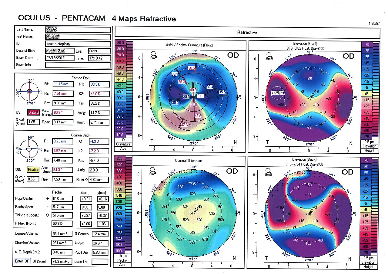 Mapeamento corneal usado no planejamento do transplante endotelial